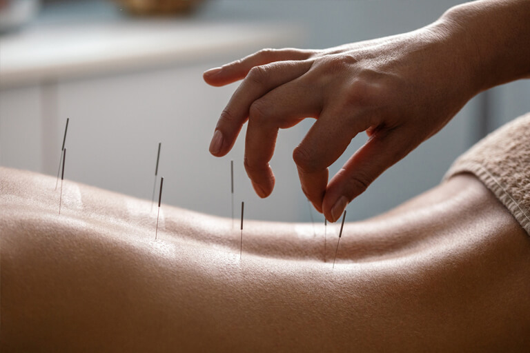 acupuncture-in-wisconsin acupuncture-in-wisconsin